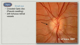 • Crowded Optic disc
(Pseudo swelling)
• with tortuous retinal
vessels
Small eye
 