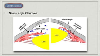 • Narrow angle Glaucoma
 