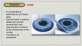 • A corneal flap is
fashioned by an Femto
laser
• Excimer laser is used to
ablate the corneal
stromal bed, thus
reducing the curvature
of the central part of the
cornea
• The flap is re-
positioned
LASIK
 