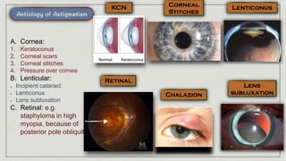 A. Cornea:
1. Keratoconus
2. Corneal scars
3. Corneal stitches
4. Pressure over cornea
B. Lenticular:
Incipient cataract
Lenticonus
Lens subluxation
C. Retinal: e.g.
staphyloma in high
myopia, because of
posterior pole obliquity
 