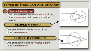 • One principal meridian is emmetropic & the
other is ametropic, with accommodation
relaxed
• One principal meridian is Myopic & the
other is emmetropic
• One principal meridian is Hyperopic & the
other is emmetropic
 