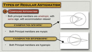• Both principal meridians are ametropic, with
same sign, with accommodation relaxed
• Both Principal meridians are myopic
• Both Principal meridians are hyperopic
 
