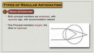 • Both principal meridians are ametropic, with
opposite sign, with accommodation relaxed
• One Principal meridians myopic, the
other is hyperopic
 