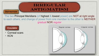 The two Principal Meridians (of highest & lowest power) are NOT at right angle
to each others, and change of power from one meridian to the other is NEITHER
gradual NOR regular
• Corneal scars
• KCN
 