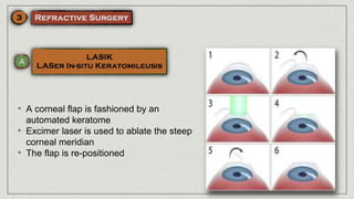 • A corneal flap is fashioned by an
automated keratome
• Excimer laser is used to ablate the steep
corneal meridian
• The flap is re-positioned
 
