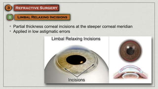 • Partial thickness corneal incisions at the steeper corneal meridian
• Applied in low astigmatic errors
 