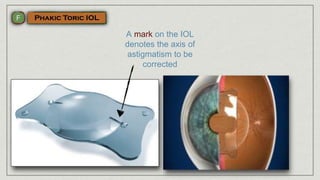 A mark on the IOL
denotes the axis of
astigmatism to be
corrected
 