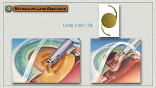 Using a toric IOL
 