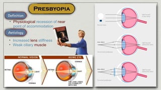 • Physiological recession of near
point of accommodation
• Increased lens stiffness
• Weak ciliary muscle
 