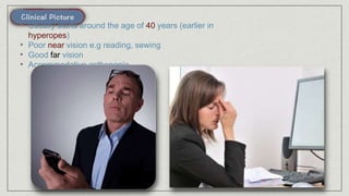 • Usually starts around the age of 40 years (earlier in
hyperopes)
• Poor near vision e.g reading, sewing
• Good far vision
• Accommodative asthenopia
 