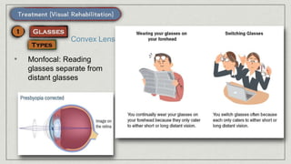 • Monfocal: Reading
glasses separate from
distant glasses
Convex Lens
 