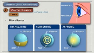 Convex Lens
• Bifocal lenses
 