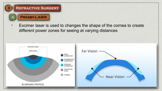 • Excimer laser is used to changes the shape of the cornea to create
different power zones for seeing at varying distances
 