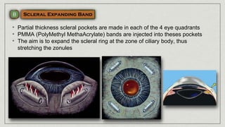 • Partial thickness scleral pockets are made in each of the 4 eye quadrants
• PMMA (PolyMethyl MethaAcrylate) bands are injected into theses pockets
• The aim is to expand the scleral ring at the zone of ciliary body, thus
stretching the zonules
 