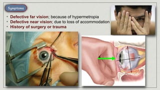 • Defective far vision; because of hypermetropia
• Defective near vision; due to loss of accommodation
• History of surgery or trauma
 
