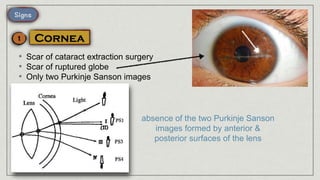 • Scar of cataract extraction surgery
• Scar of ruptured globe
• Only two Purkinje Sanson images
absence of the two Purkinje Sanson
images formed by anterior &
posterior surfaces of the lens
 