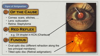 • Cornea: scars, stitches, …
• Lens: subluxation
• Retina: Staphyloma
• e.g. Oil droplet in KCN (Charleux)
• Oval optic disc (different refraction along the
two principal meridians)
• Tilted optic disc (Retinal astigmatism)
 