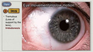 • Tremulous
(Loss of
support by the
lens),
Iridodonesis
 