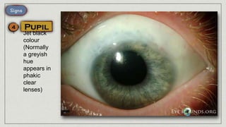 • Jet black
colour
(Normally
a greyish
hue
appears in
phakic
clear
lenses)
 