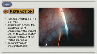 • High hypermetropia (+ 10
D or more)
• Astigmatism Against the
rule (Because of
contraction of the corneal
scar at 12 o’clock position,
causing flattening of the
vertical meridian)
• Anisometropia (In
unilateral aphakia)
 