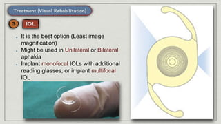 It is the best option (Least image
magnification)
Might be used in Unilateral or Bilateral
aphakia
Implant monofocal IOLs with additional
reading glasses, or implant multifocal
IOL
 