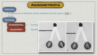 • A difference of refractive power between the two eyes of 4 D or
more
• Common
• Aphakia
 