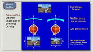 Anis-eiokonia
Different
image size in
both eyes
(>30%)
 