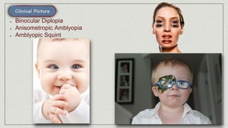Binocular Diplopia
Anisometropic Amblyopia
Amblyopic Squint
 