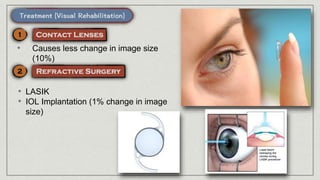 • Causes less change in image size
(10%)
• LASIK
• IOL Implantation (1% change in image
size)
 