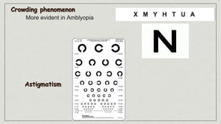 More evident in Amblyopia
 