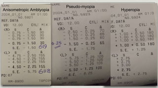 Hyperopia
Pseudo-myopia
Anisometropic Amblyopia
 