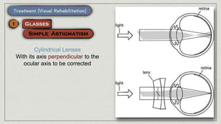 Cylindrical Lenses
With its axis perpendicular to the
ocular axis to be corrected
 
