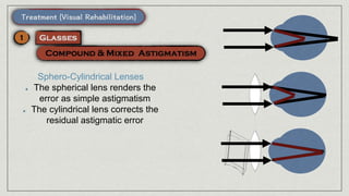 Sphero-Cylindrical Lenses
The spherical lens renders the
error as simple astigmatism
The cylindrical lens corrects the
residual astigmatic error
 