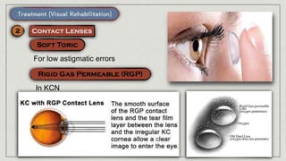 For low astigmatic errors
In KCN
 