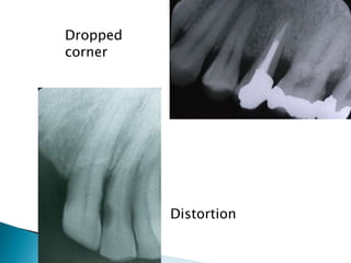 Errors of dental radiography | PPTX