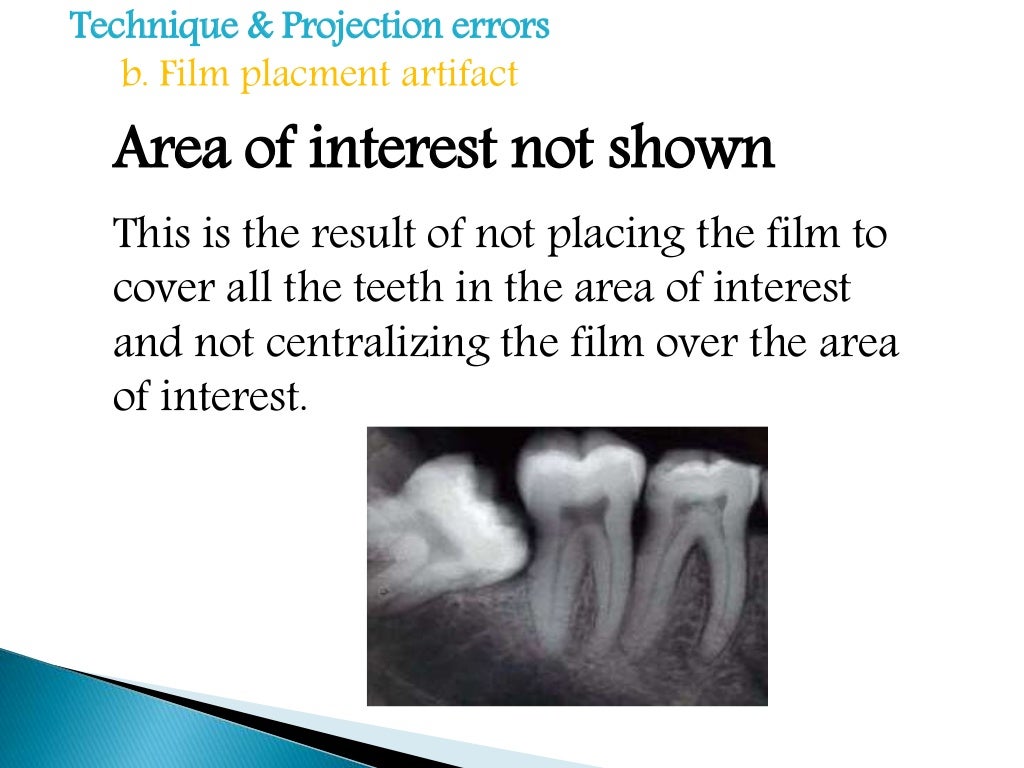 Errors of dental radiography