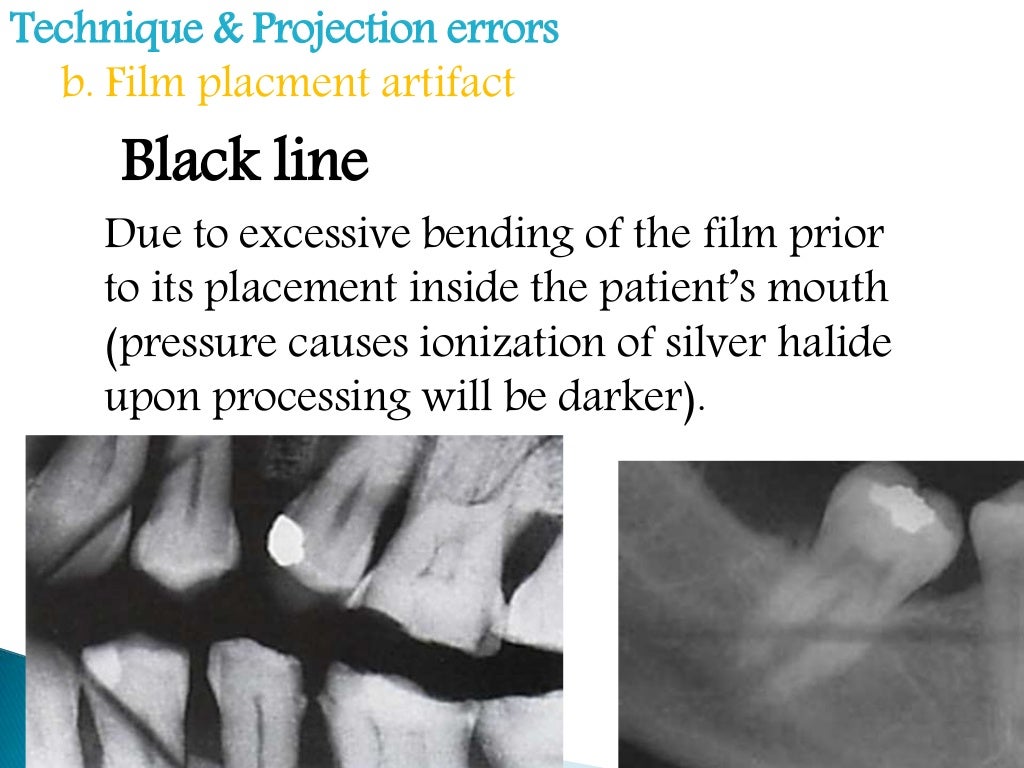 Errors of dental radiography