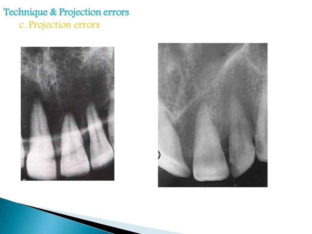 Errors of dental radiography