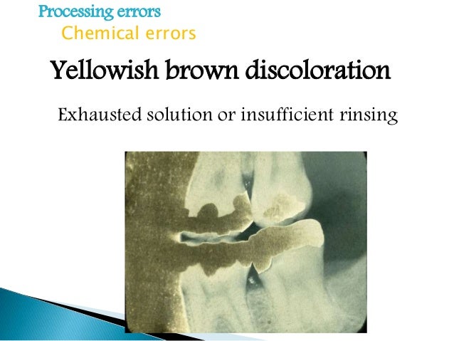 Errors of dental radiography