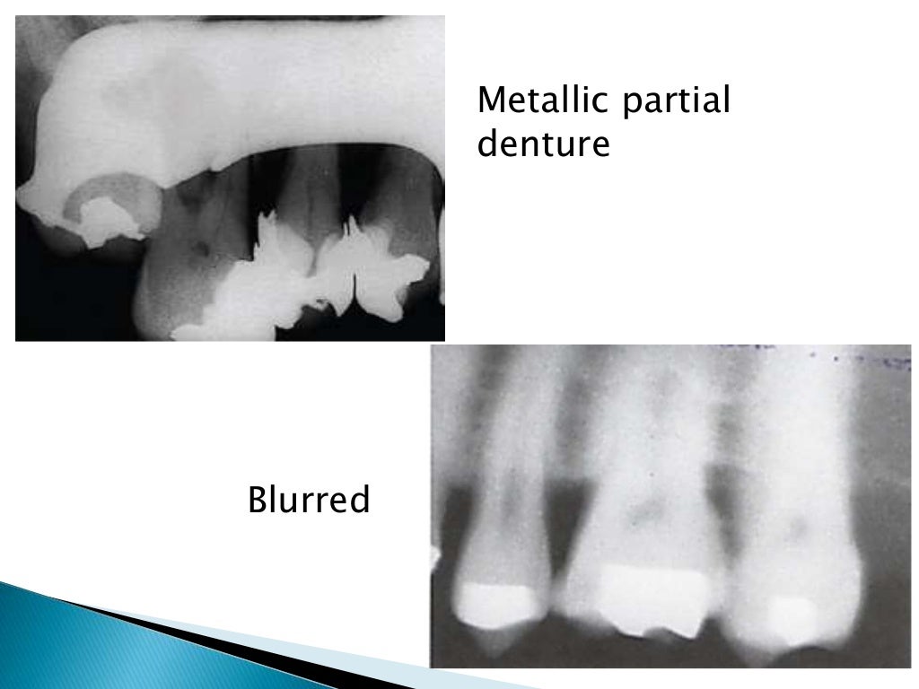 Errors of dental radiography