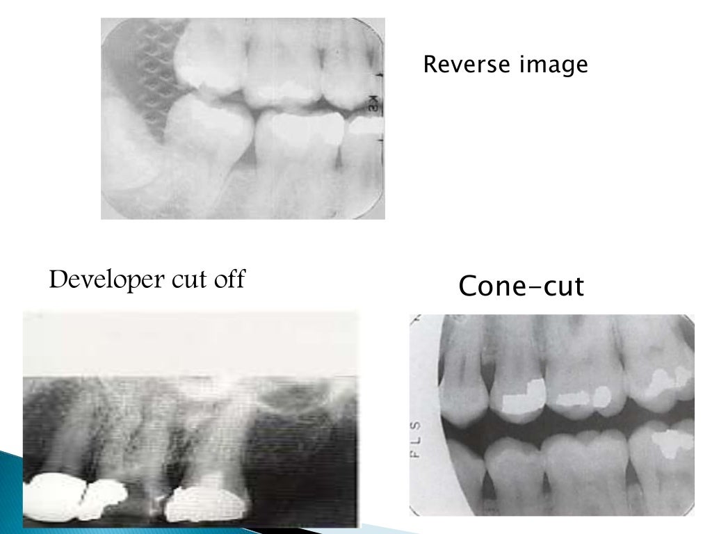 Errors of dental radiography
