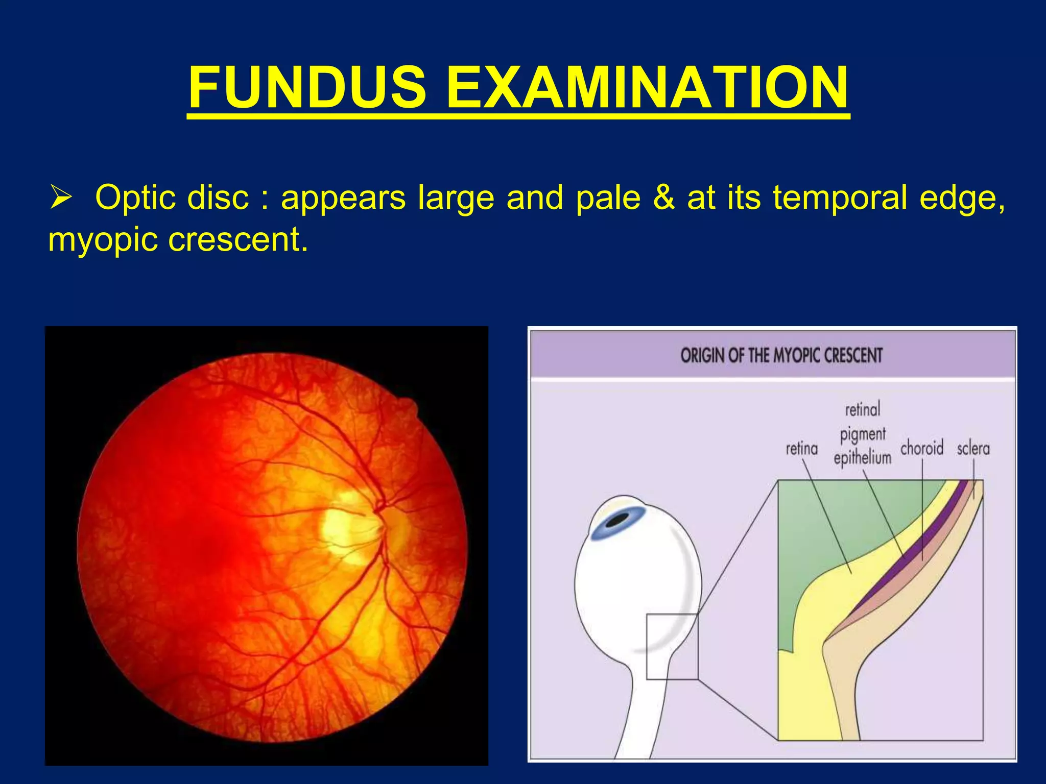 FUNDUS EXAMINATION
 Optic disc : appears large and pale & at its temporal edge,
myopic crescent.
 