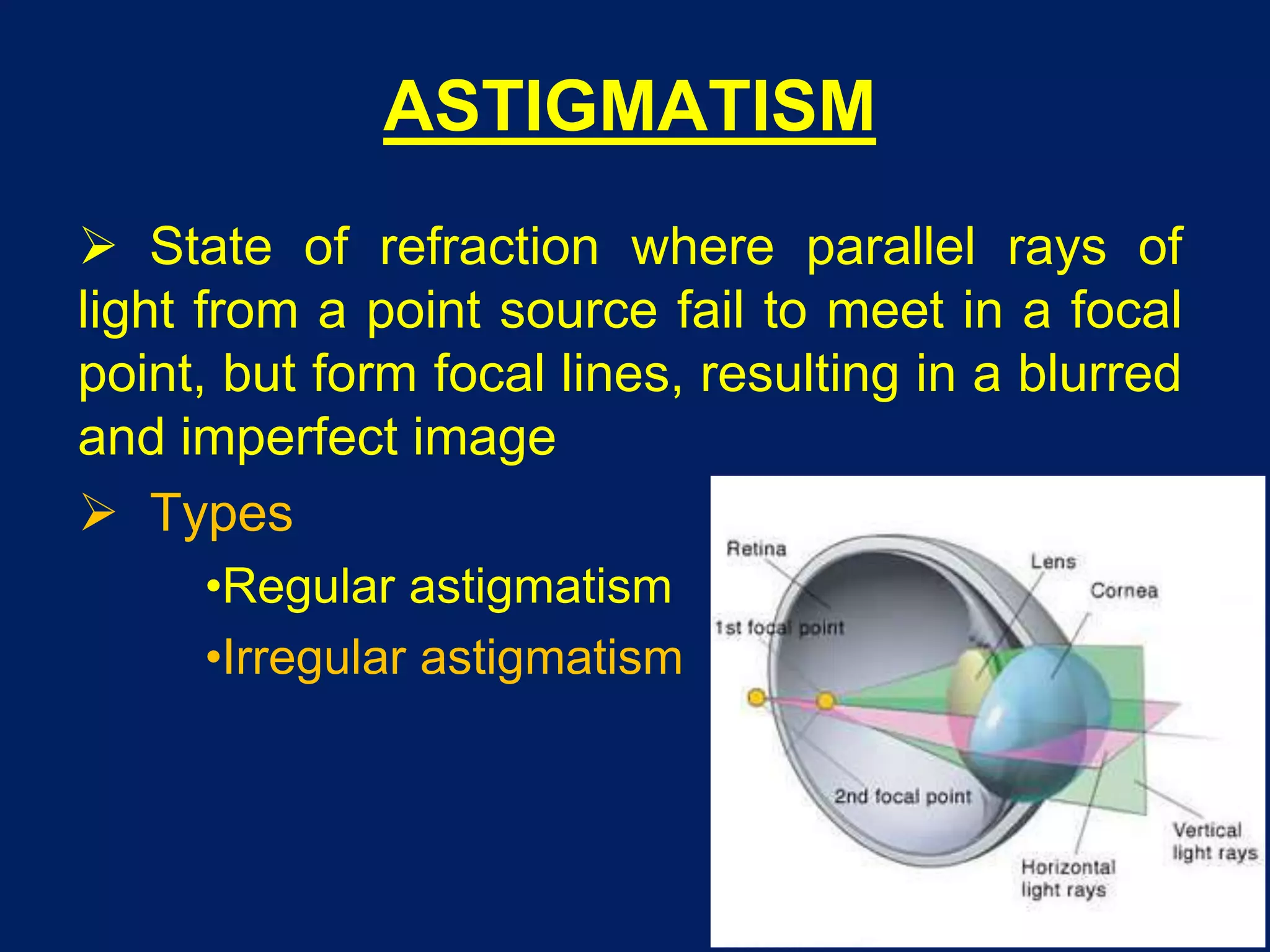 ASTIGMATISM
 State of refraction where parallel rays of
light from a point source fail to meet in a focal
point, but form focal lines, resulting in a blurred
and imperfect image
 Types
•Regular astigmatism
•Irregular astigmatism
 