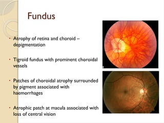 ERRORS OF REFRACTION AND BINOCULAR OPTIC DEFECTS.pptx