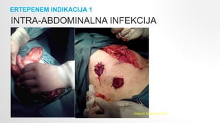 ERTEPENEM INDIKACIJA 1
INTRA-ABDOMINALNA INFEKCIJA
Stošić M, Stojković M, 2013
 