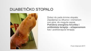 DIJABETIČKO STOPALO
Dolazi do pada krivine stopala;
Zapaljenja su difuzna i vremenom
sve gora, do moguće sepse
Potrebna energična hirurška i
antibiotska terapija – ertapenemom
kao i podržavajuća terapija.
From Internet 2017.
 
