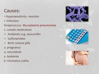 Causes:
• Hypersensitivity reaction
1- Infection:
Streptcoccus, Mycoplasma pneumoniae
2- certain medication:
• Antibiotic e.g. amoxicillin
• Sulfonamides
• Birth control pills
3- pregnancy
4- sarcoidosis
5- leukemia
6- Ulcerative colitis