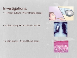 Investigations:
• 1- Throat culture for streptococcus
• 2- Chest X-ray sarcoidosis and TB
• 3- Skin biopsy for difficult cases