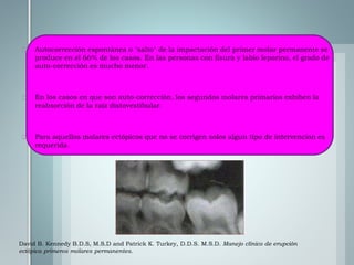 David B. Kennedy B.D.S, M.S.D and Patrick K. Turkey, D.D.S. M.S.D. Manejo clínico de erupción
ectópica primeros molares permanentes.
 