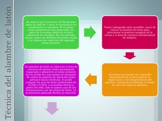 Técnicadelalambredelatón
Se observa por 3-6 meses. Si EE persiste
hasta la edad de 7 años, el tratamiento es
usualmente un mandato. Si el primer
molar permanente esta impactado con
parte de la corona visible en la boca
raramente se corregirá. En este periodo,
checar caries sin detectar del primer molar
y la reabsorción radicular del segundo
molar primario.
Tomar radiografía aleta mordible, antes de
colocar el alambre de latón para
determinar la posición marginal de la
cresta y el área de contacto interproximal
de molares.
Anestesia local puede ser requerida
dependiendo de la severidad de la
impactacion y del temperamento del
paciente. Anestesiar localmente en fondo
de saco así como en palatino.
Un alambre de latón se coloca en el área de
contacto del primer molar permanente
impactado y adyacente al molar primario
con la ayuda de unas pinzas de mosquito.
Se coloca de palatino de distal del molar
primario hacia vestibular. E puede
comprar los aros de latón preformados de
(0.020 o 0.025), o se pueden formar a
partir del rollo, solo se aplana una de las
terminaciones con las pinzas de howe. La
terminación aplanada facilita la inserción.
 